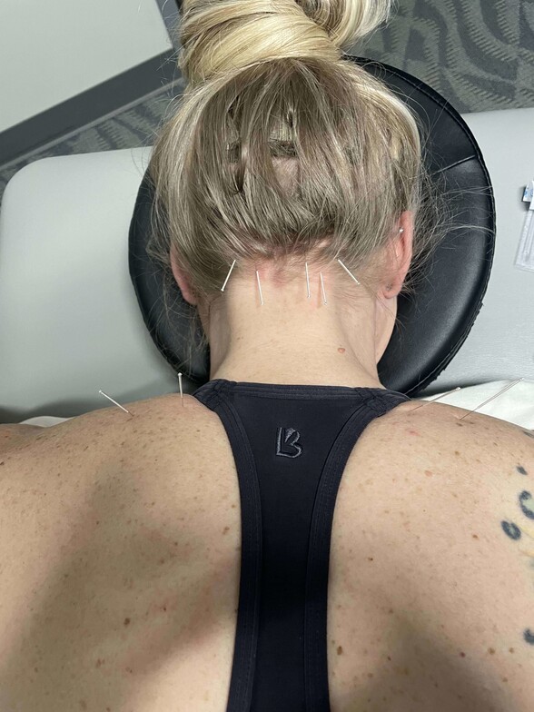 chiropractor, dry needling, acupuncture, dry needling Denver, sports injury, sports doc, Thornton Chiropractor