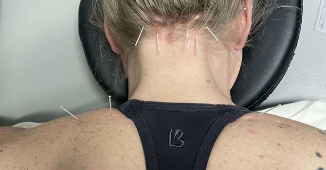 Denver Area Chiropractor Explains How Dry Needling Relieves Muscle Pain image